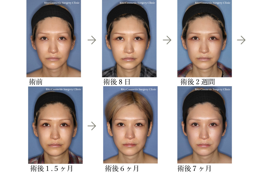 症例写真:頬骨セットバック術
