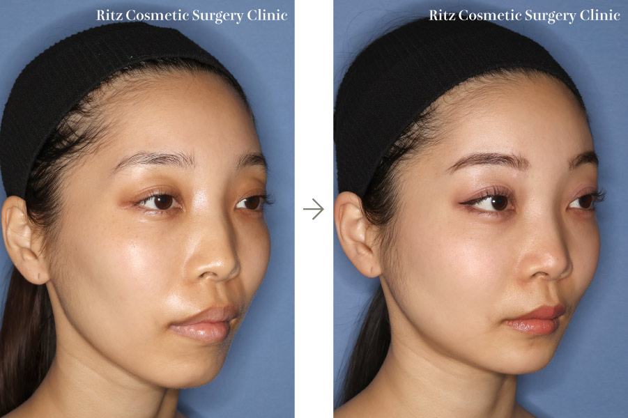 症例写真：ルフォーⅠ型骨切り術（LeFort-1）＋下顎枝矢状分割術（SSRO）（上方移動:4㎜＋後方移動:3㎜）オトガイ形成術（短縮＋前進）