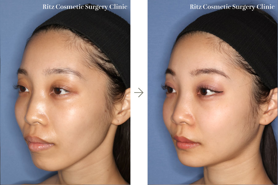 症例写真：ルフォーⅠ型骨切り術（LeFort-1）＋下顎枝矢状分割術（SSRO）（上方移動:4㎜＋後方移動:3㎜）オトガイ形成術（短縮＋前進）