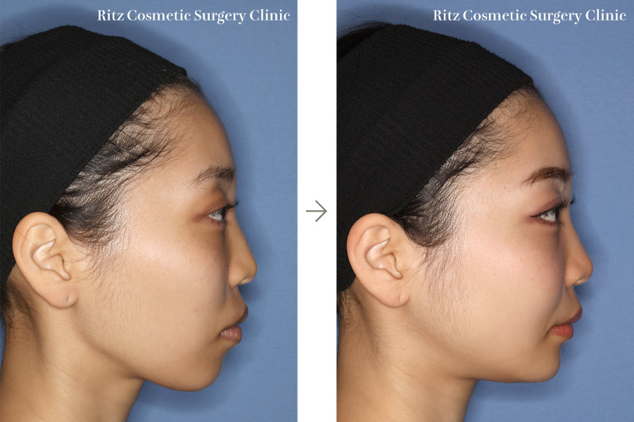 症例写真：ルフォーⅠ型骨切り術（LeFort-1）＋下顎枝矢状分割術（SSRO）（上方移動:4㎜＋後方移動:3㎜）オトガイ形成術（短縮＋前進）