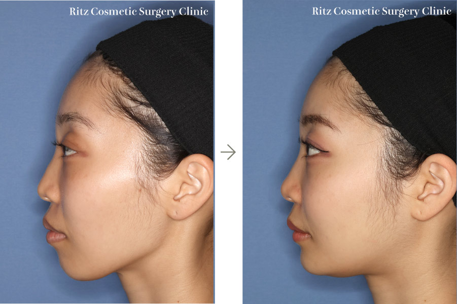 症例写真：ルフォーⅠ型骨切り術（LeFort-1）＋下顎枝矢状分割術（SSRO）（上方移動:4㎜＋後方移動:3㎜）オトガイ形成術（短縮＋前進）