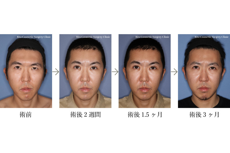 症例写真：前頭洞骨切り術＋上眼瞼リフト＋頬骨縮小術＋鼻シリコンプロテーゼ