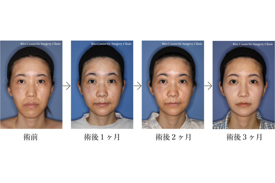 症例写真:ルフォーⅠ型骨切り術(LeFort-1)+下顎枝矢状分割術(SSRO)(上方移動+後方移動+時計回転)+オトガイ形成術(短縮+前進)