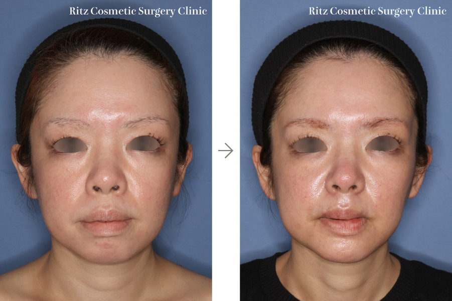 症例写真：下顎枝矢状分割術（SSRO）＋ルフォーI型骨切り術（LeFort-1）＋オトガイ形成術（前進＋細く）