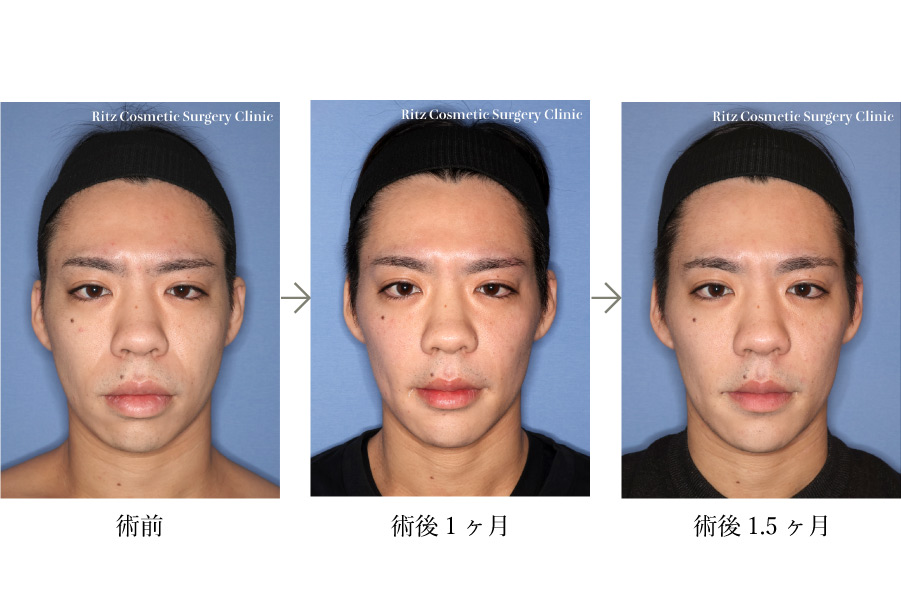 症例写真：前歯部歯槽骨切り術 (ASO)