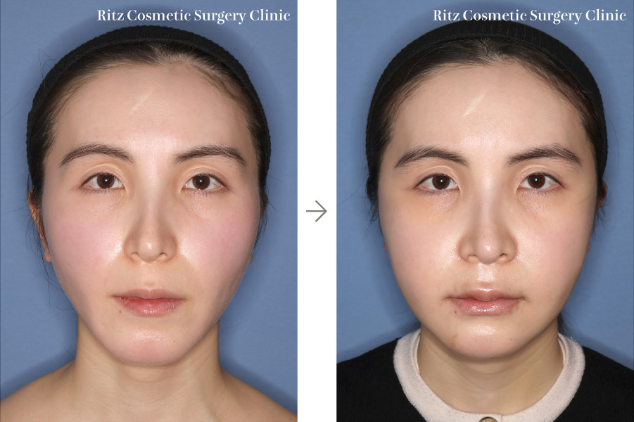 症例写真:下顎枝矢状分割術(SSRO)+ルフォーI型骨切り術(LeFort-1)+オトガイ形成術(前進+細く)+頬骨縮小術