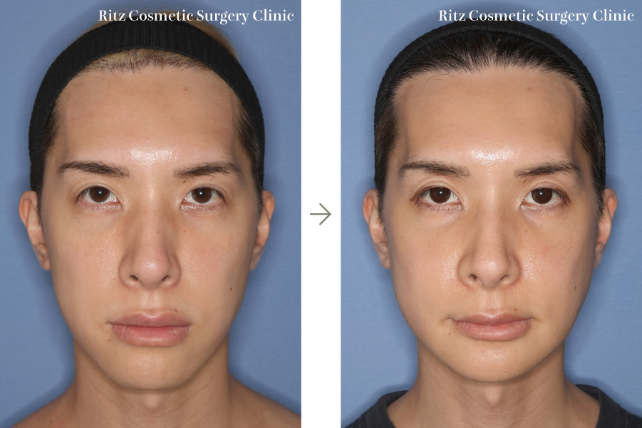 症例写真:ルフォーI型骨切り術(LeFort-1)+下顎枝矢状分割法(SSRO)+オトガイ形成術(短縮+前進)