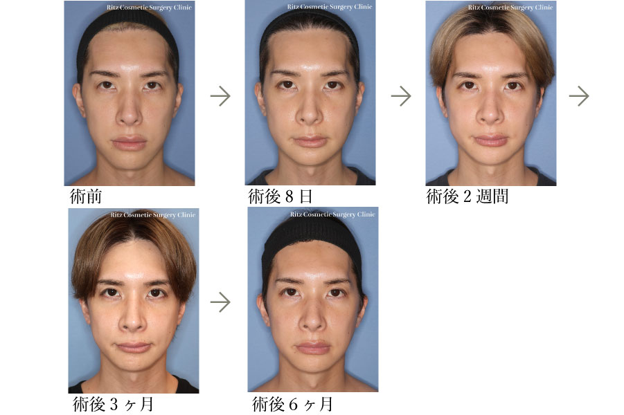症例写真:ルフォーI型骨切り術(LeFort-1)+下顎枝矢状分割法(SSRO)+オトガイ形成術(短縮+前進)