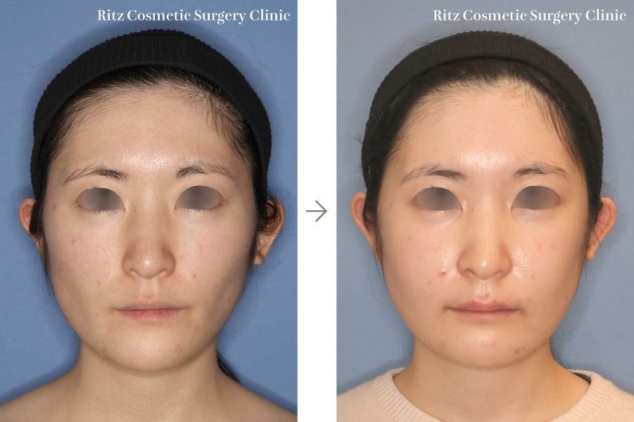 症例写真:下顎枝矢状分割術(SSRO)+ルフォーI型骨切り術(LeFort-1)(上方移動+前進移動+時計回転)+頬骨縮小術