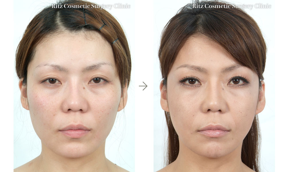 頬骨縮小術+下顎形成術＋オトガイVライン形成術の症例写真