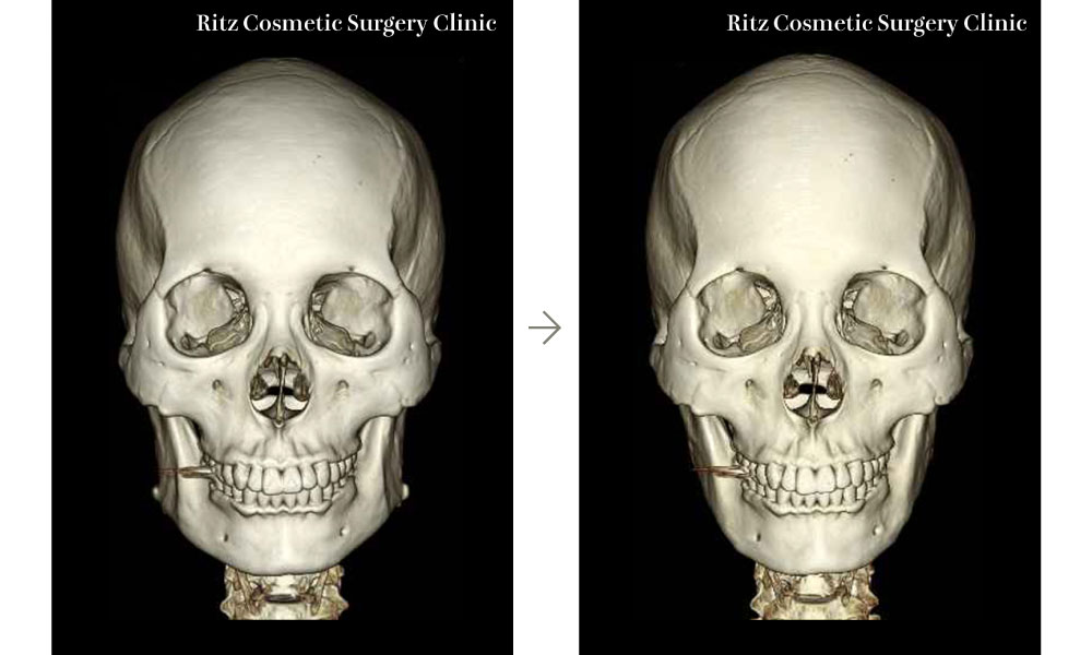 症例写真：下顎形成術＋二重アゴ脂肪吸引の3D-CT