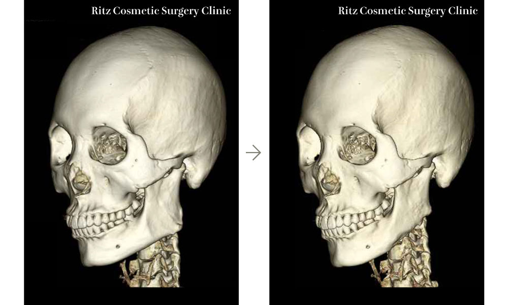 症例写真：下顎角形成術＋二重アゴ脂肪吸引の3D-CT術前