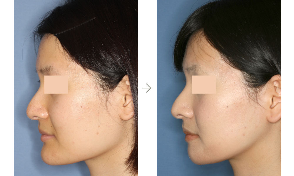 症例写真：下顎形成術＋オトガイVライン形成術(左側面)