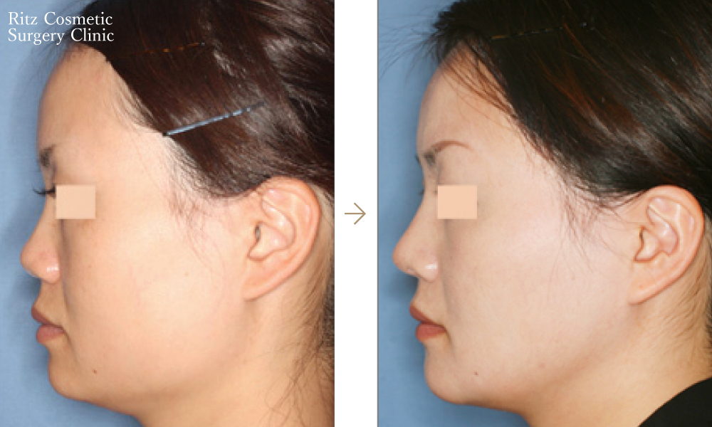症例写真：下顎形成術＋オトガイVライン形成術(左側面)