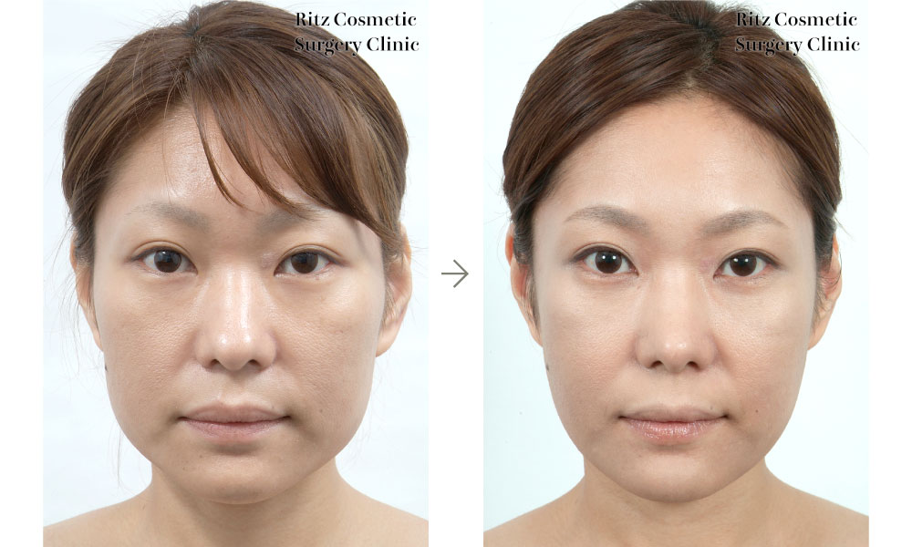 下顎形成術（拡大下顎角切除＋外板切除）＋頬骨縮小術の症例写真