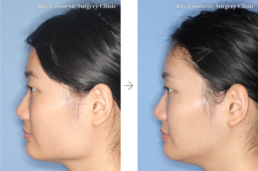 症例写真（腫れの変化）：オトガイVライン形成術＋下顎形成術