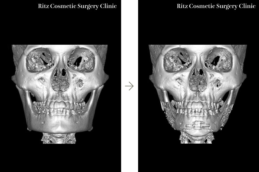 症例写真：Vライン形成術＋オトガイ部ホームベース型骨切り術