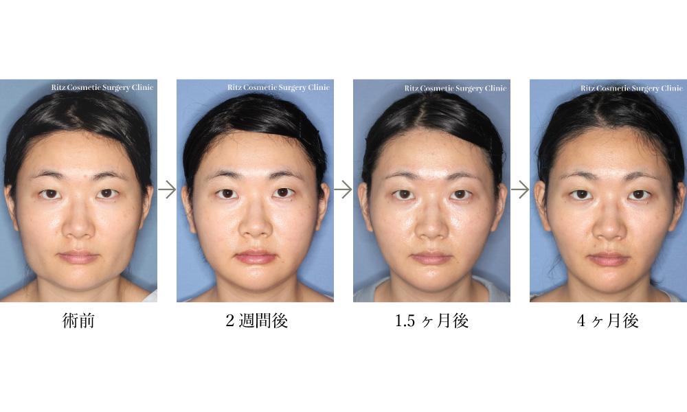 症例写真：オトガイVライン形成術＋下顎形成術