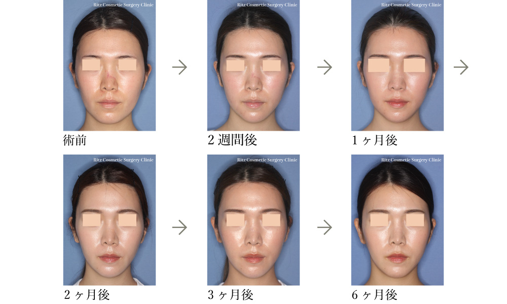 症例写真（腫れの変化）：オトガイVライン形成術＋下顎形成術