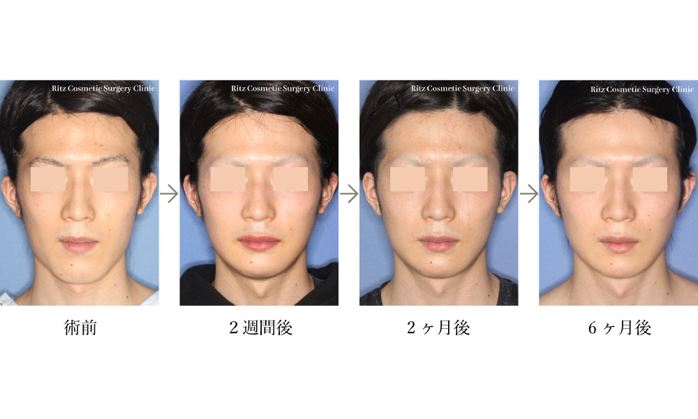 症例写真：下顎角形成術＋オトガイ水平骨切り術