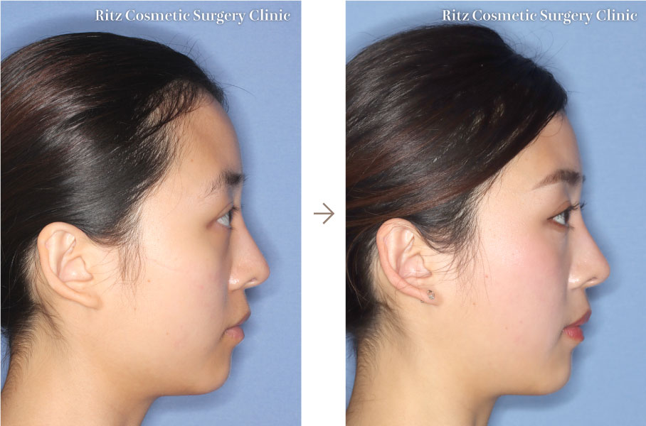 症例写真：下顎角形成術（下顎角切除＋外板切除＋咬筋焼灼）(右側面)