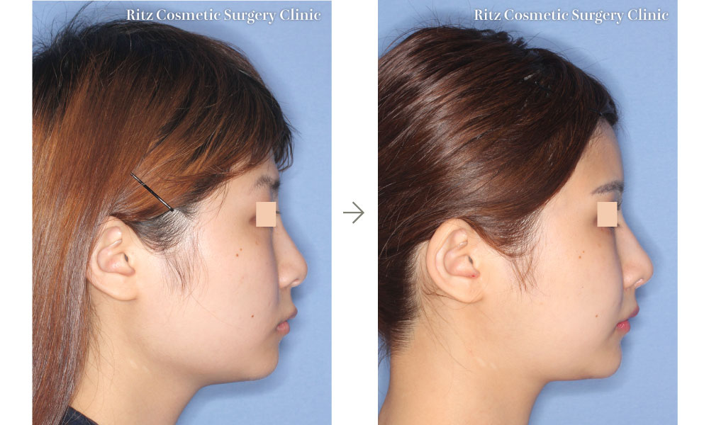 症例写真：下顎角形成術（下顎角切除＋外板切除＋咬筋焼灼）＋頬骨縮小術＋オトガイ形成術(右側面)