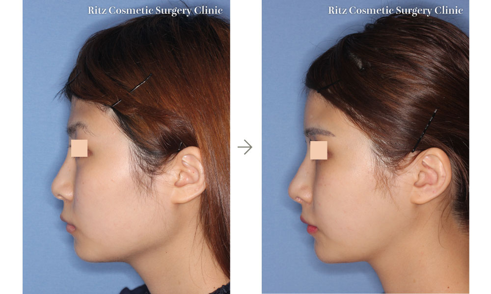 症例写真：下顎角形成術（下顎角切除＋外板切除＋咬筋焼灼）＋頬骨縮小術＋オトガイ形成術(左側面)