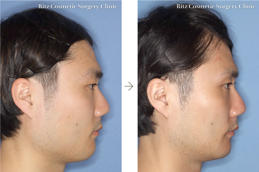 症例写真：下顎Vライン形成術（下顎角切除＋外板切除＋咬筋焼灼）(左側面)