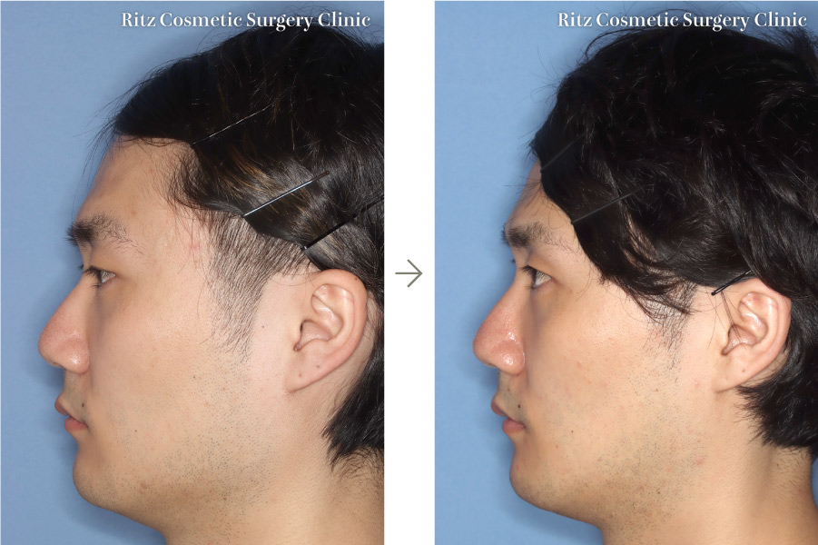 症例写真：下顎Vライン形成術（下顎角切除＋外板切除＋咬筋焼灼）(左側面)