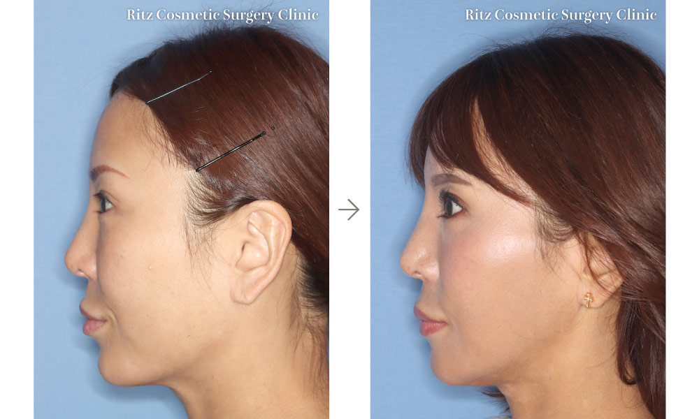 症例写真：下顎Vライン形成術（下顎角切除＋外板切除）(右側面)