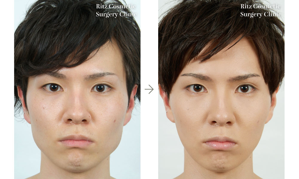 症例写真：下顎角切除＋外板切除＋咬筋減量(正面)