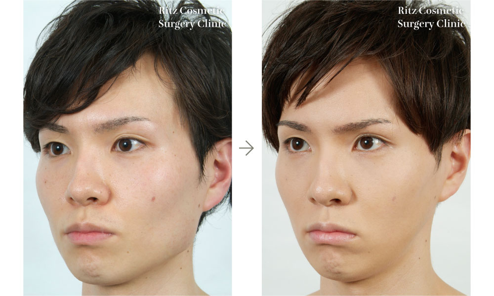 症例写真：下顎角切除＋外板切除＋咬筋減量(左側面)