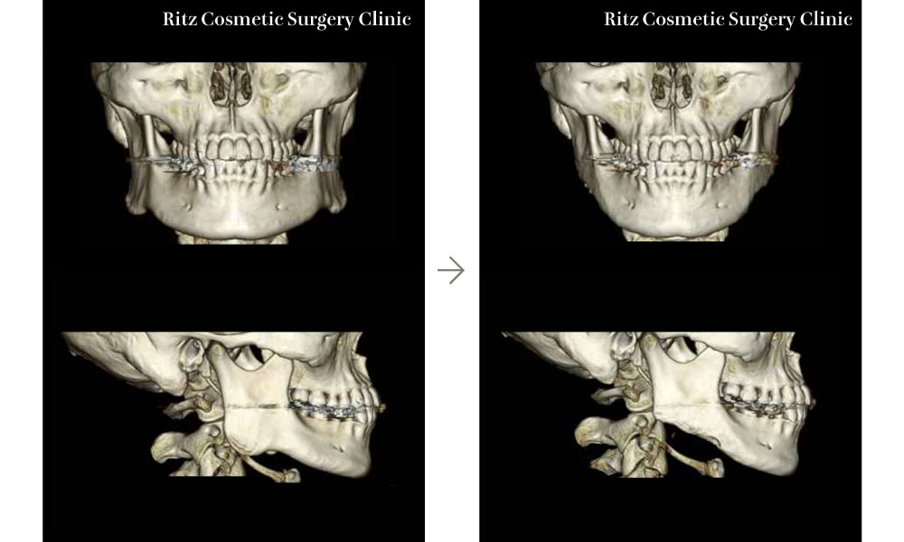 症例写真：下顎角切除＋外板切除＋咬筋減量の3D-CT