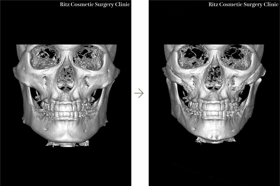 症例写真：下顎形成術（下顎角切除＋外板切除＋咬筋焼灼）＋頬骨縮小術＋オトガイ形成術(右斜め)
