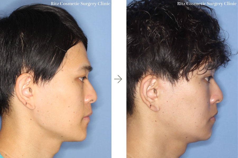症例写真：下顎形成術（下顎角切除＋外板切除＋咬筋焼灼）＋頬骨縮小術＋オトガイ形成術(右側面)