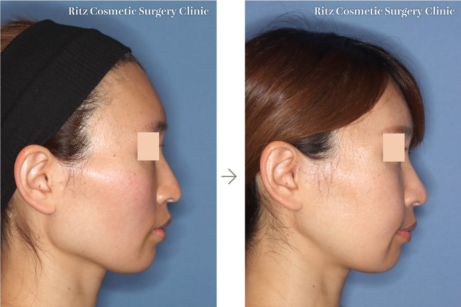 症例写真：下顎形成術（下顎角切除＋外板切除＋咬筋焼灼）＋頬骨縮小術(右側面)
