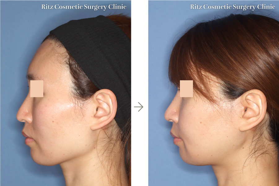 症例写真：下顎形成術（下顎角切除＋外板切除＋咬筋焼灼）＋頬骨縮小術(左側面)