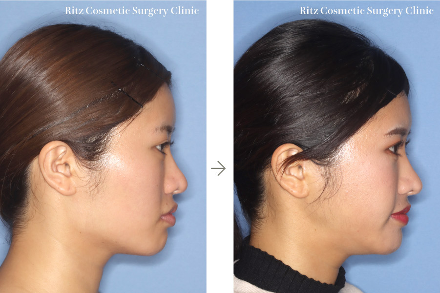 症例写真：下顎形成術（下顎角切除＋外板切除）＋頬骨縮小術＋オトガイ水平骨切り術（短縮）
