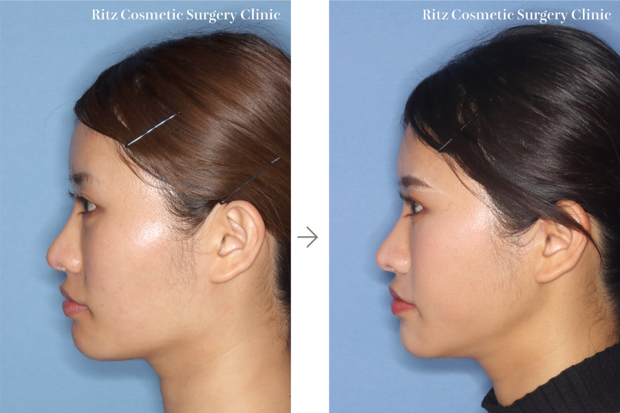 症例写真：下顎形成術（下顎角切除＋外板切除）＋頬骨縮小術＋オトガイ水平骨切り術（短縮）
