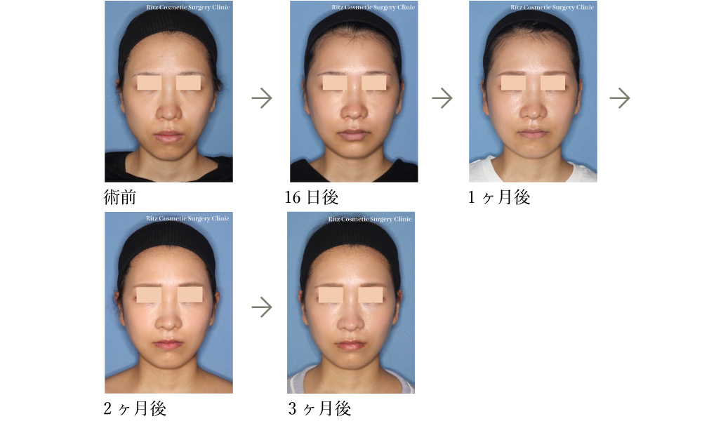 症例写真：下顎枝矢状分割法（SSRO）＋ルフォーI型骨切り術（LeFort-1）＋下顎形成術（下顎角切除＋外板切除）＋頬骨縮小術