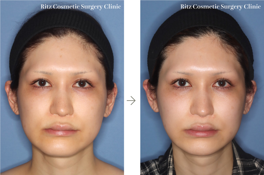 症例写真：オトガイVライン形成術＋下顎形成術（外板切除）