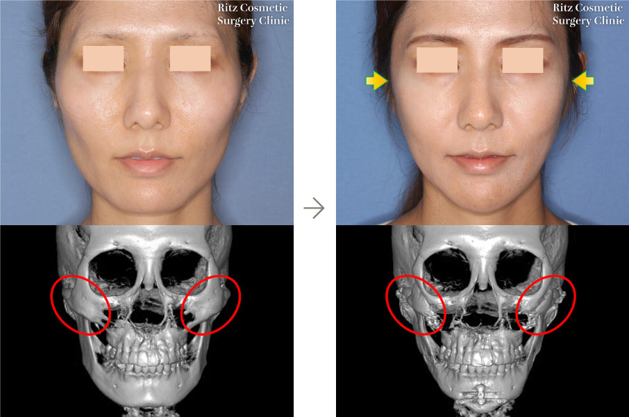 症例写真：頬骨縮小術＋下顎形成術（拡大下顎角切除＋外板切除）＋オトガイVライン形成術(正面)