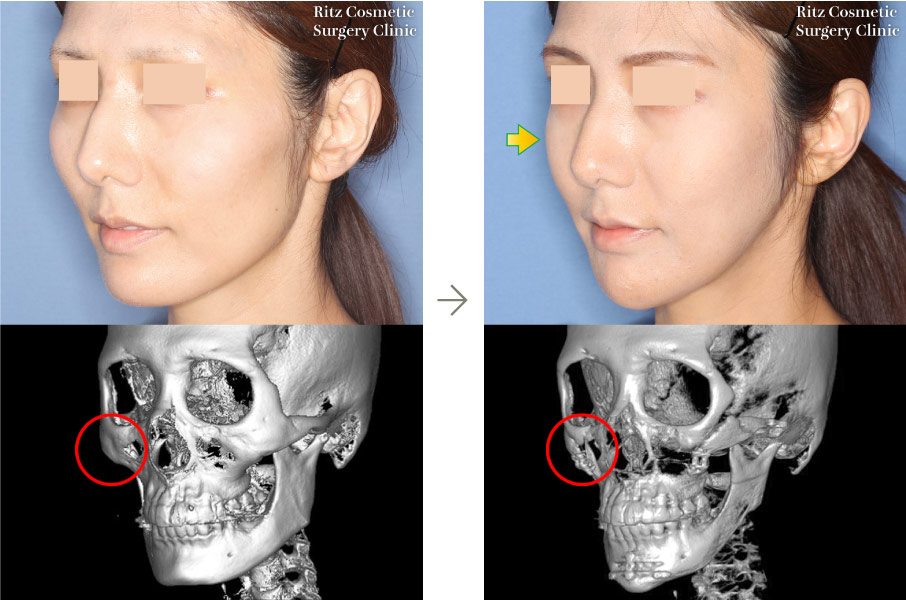 症例写真：頬骨縮小術＋下顎形成術（拡大下顎角切除＋外板切除）＋オトガイVライン形成術(左斜め)
