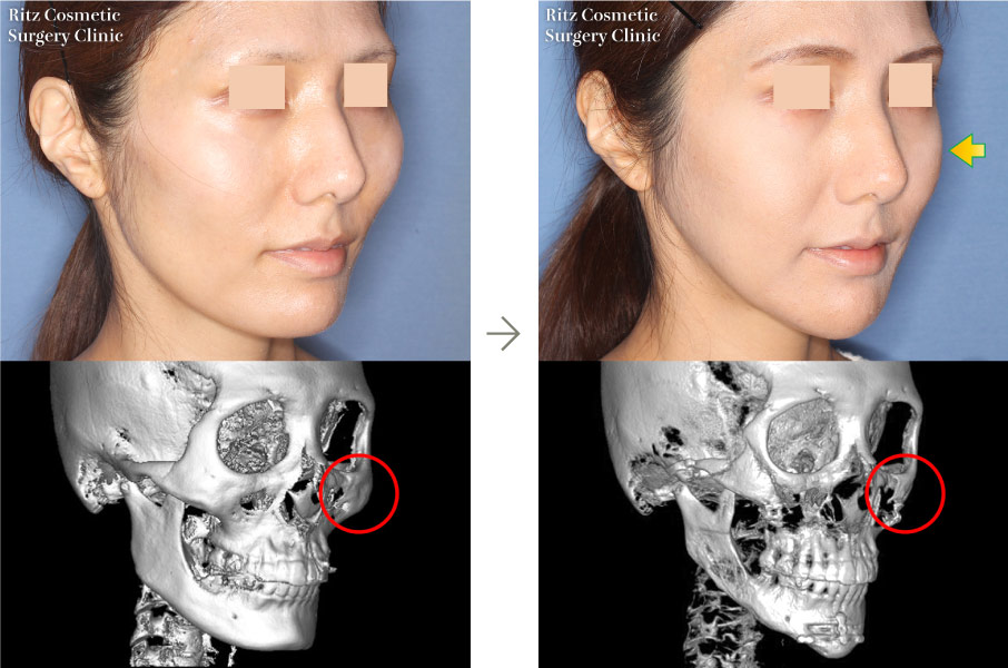 症例写真：下顎角形成術（拡大下顎角切除＋外板切除）＋頬骨縮小術＋オトガイVライン形成術(右斜め)