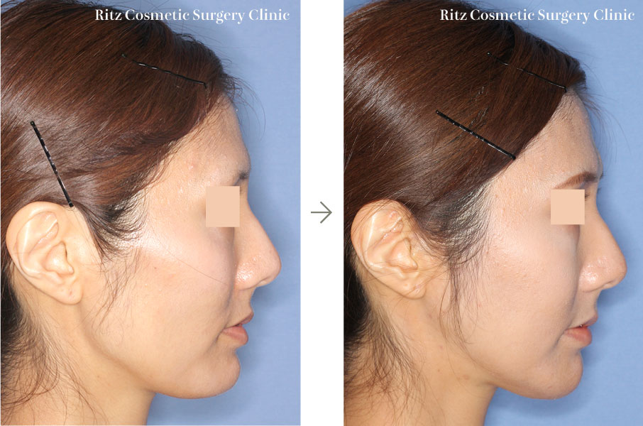 症例写真：下顎角形成術（拡大下顎角切除＋外板切除）＋頬骨縮小術＋オトガイVライン形成術