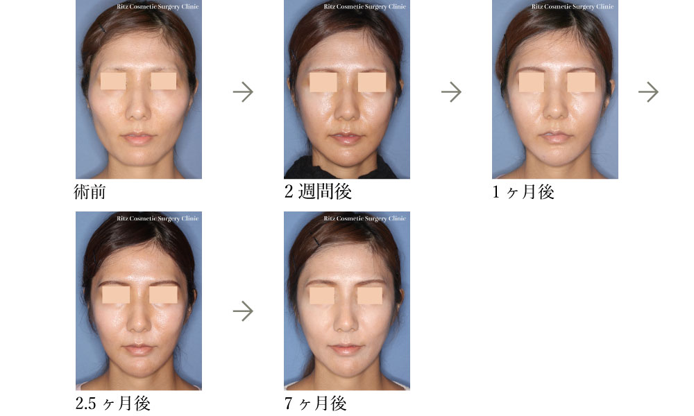 症例写真：下顎角形成術（拡大下顎角切除＋外板切除）＋頬骨縮小術＋オトガイVライン形成術