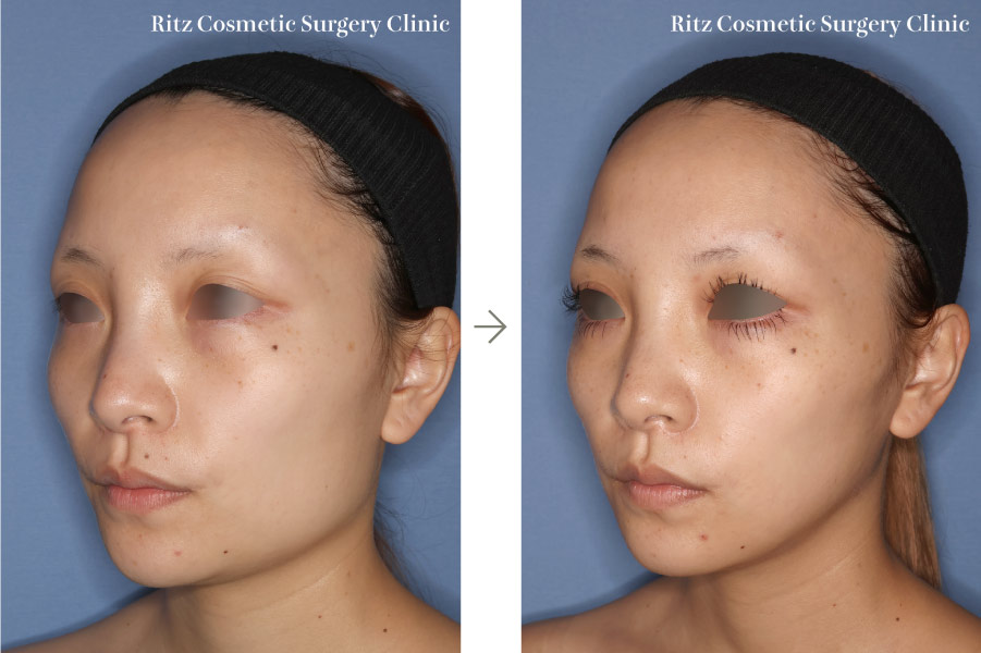 症例写真:下顎形成術(下顎角切除+外板切除)