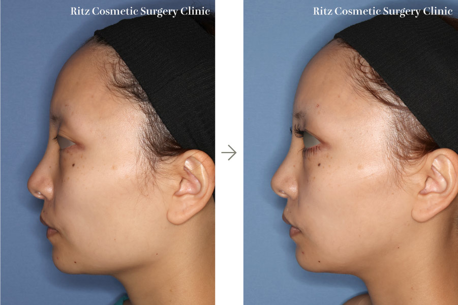 症例写真:下顎形成術(下顎角切除+外板切除)