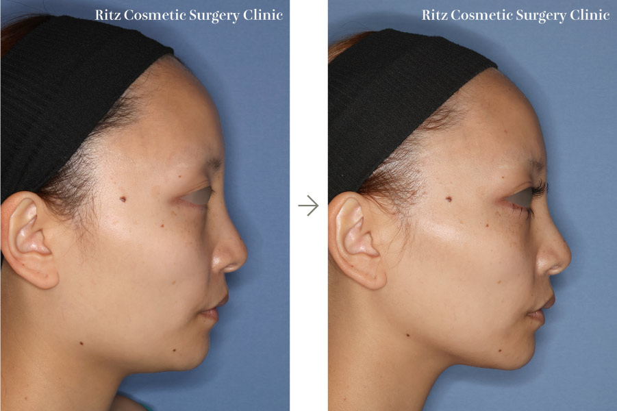 症例写真:下顎形成術(下顎角切除+外板切除)