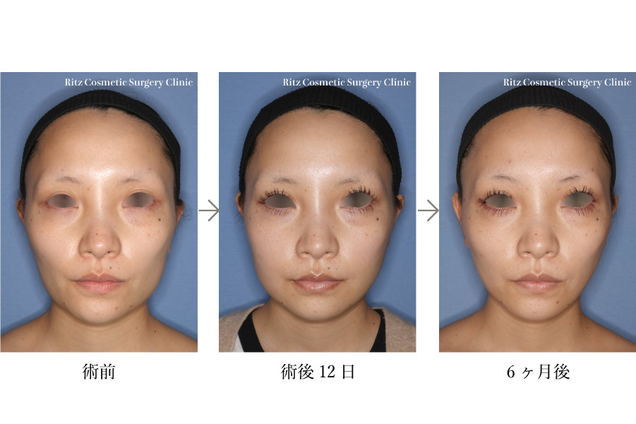 症例写真:下顎形成術(下顎角切除+外板切除)